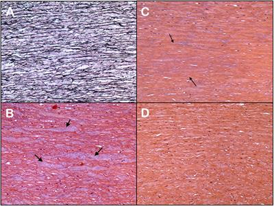 Aortic Wall Elastic Properties in Case of Bicuspid Aortic Valve